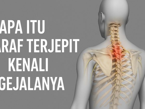 Saraf Terjepit: Penyebab, Gejala, dan Penanganan yang Tepat