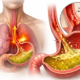 Asam Lambung (GERD)